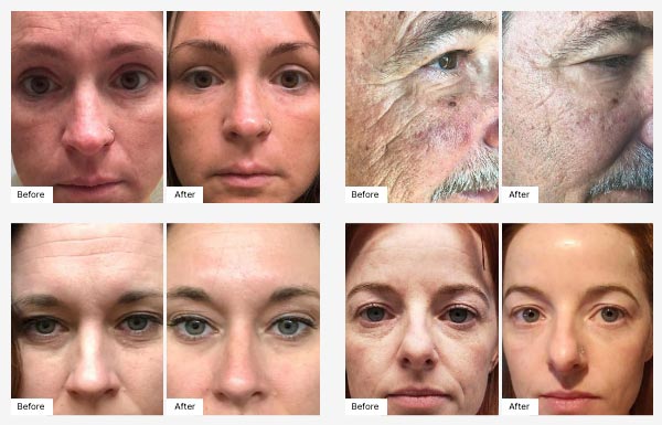 Before and After Real Results for Age IQ Day Cream